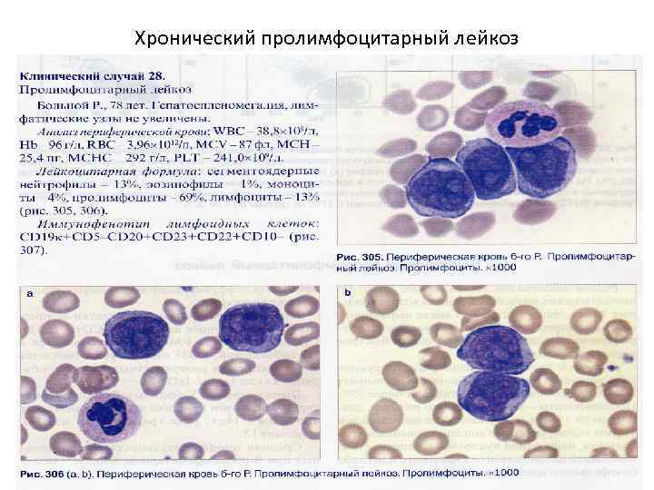 Пролимфоциты в крови фото