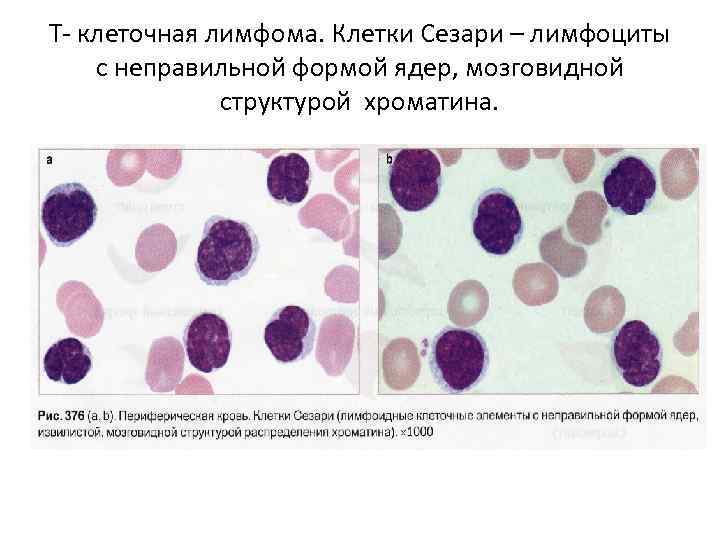 Реактивные лимфоциты в крови. Лимфоциты бластные клетки. Клетки Сезари картина крови. Лимфома Беркитта гематология. Лимфома Беркитта морфология клеток.