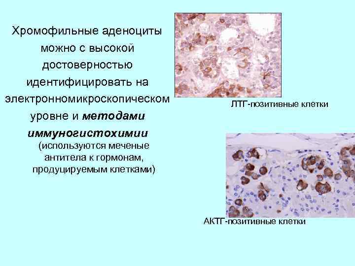Хромофильные аденоциты можно с высокой достоверностью идентифицировать на электронномикроскопическом уровне и методами иммуногистохимии ЛТГ-позитивные