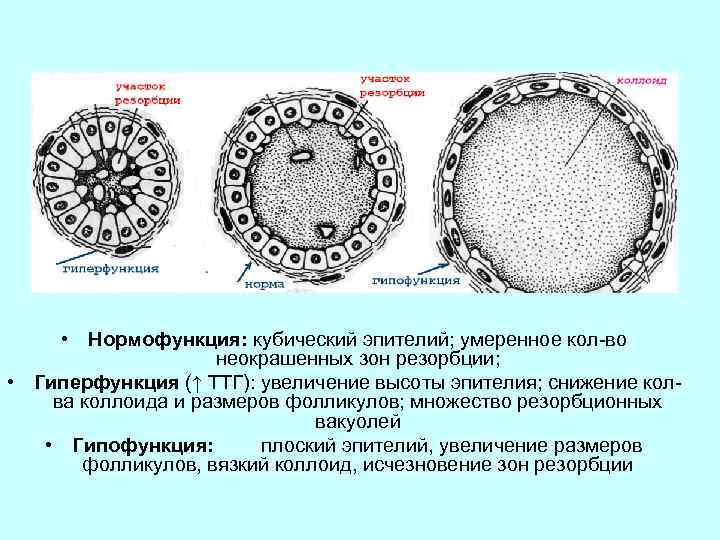  • Нормофункция: кубический эпителий; умеренное кол-во неокрашенных зон резорбции; • Гиперфункция (↑ ТТГ):