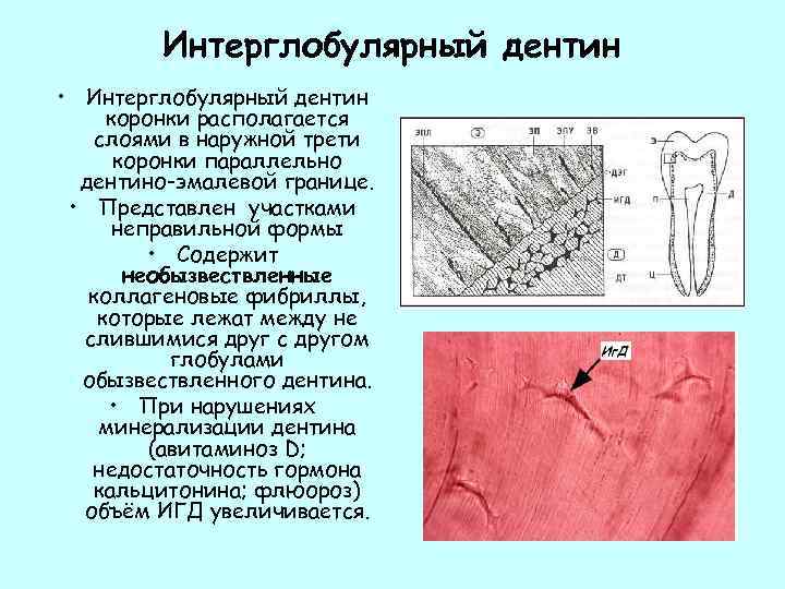 Интерглобулярный дентин • Интерглобулярный дентин коронки располагается слоями в наружной трети коронки параллельно дентино-эмалевой