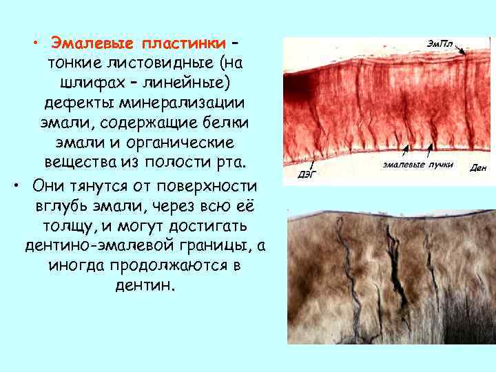  • Эмалевые пластинки – тонкие листовидные (на шлифах – линейные) дефекты минерализации эмали,