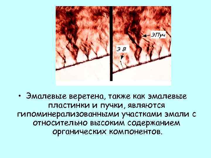  • Эмалевые веретена, также как эмалевые пластинки и пучки, являются гипоминерализованными участками эмали