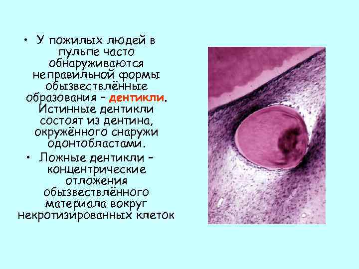  • У пожилых людей в пульпе часто обнаруживаются неправильной формы обызвествлённые образования –