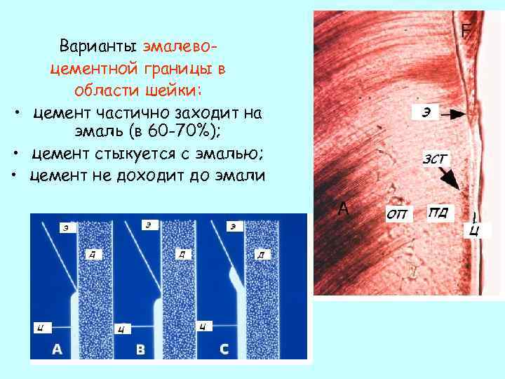 Варианты эмалевоцементной границы в области шейки: • цемент частично заходит на эмаль (в 60