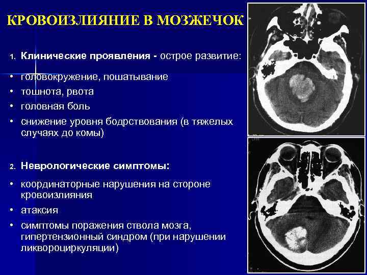 Кровоизлияние в полушарие. Кровоизлияние в мозжечок кт. Клиника кровоизлияния в мозжечок. Инсульт мозжечка кт. Для нетравматических кровоизлияний в мозжечок.