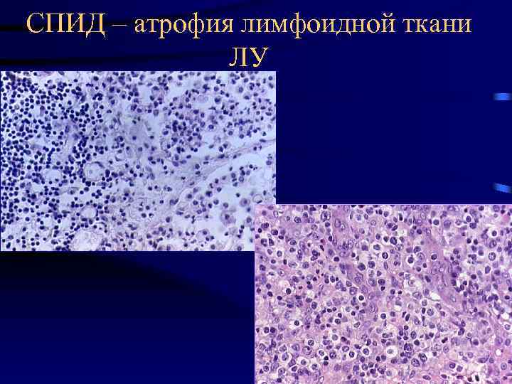 СПИД – атрофия лимфоидной ткани ЛУ 