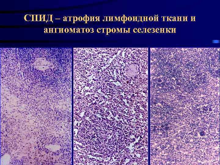 СПИД – атрофия лимфоидной ткани и ангиоматоз стромы селезенки 