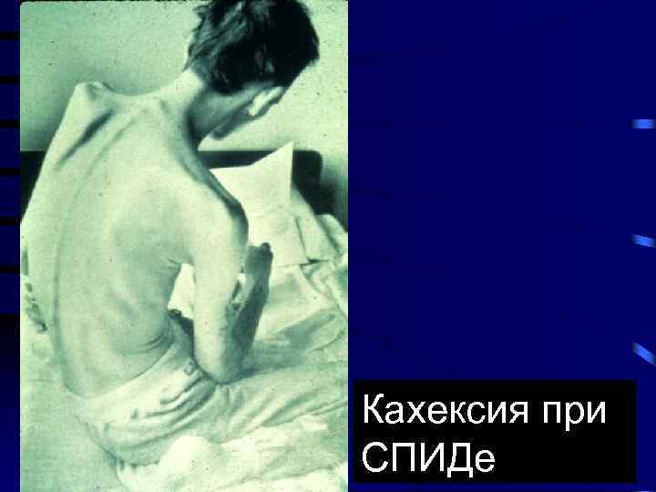 Кахексия при СПИДе 