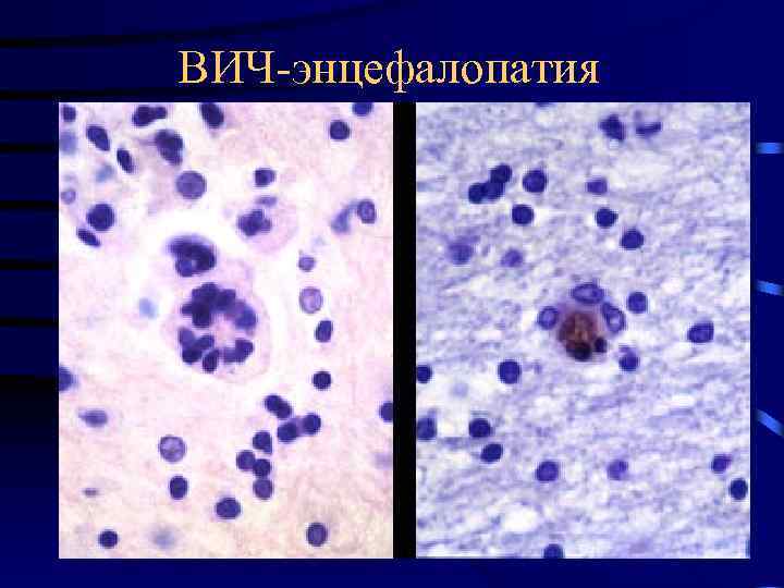 ВИЧ-энцефалопатия 