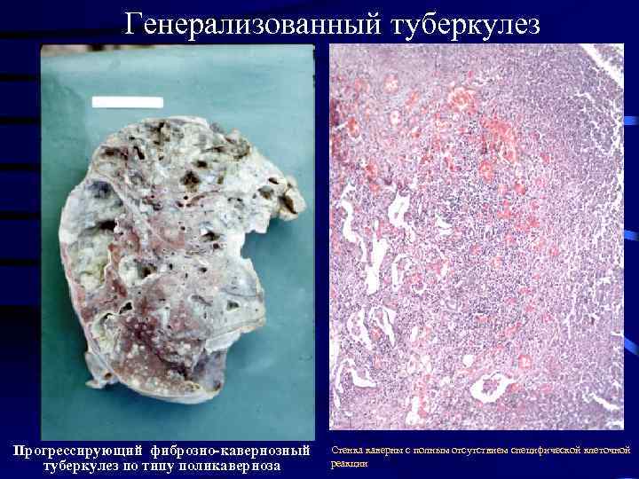 Генерализованный туберкулез Прогрессирующий фиброзно-кавернозный туберкулез по типу поликаверноза Стенка каверны с полным отсутствием специфической