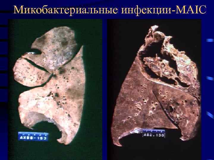 Микобактериальные инфекции-MAIC 