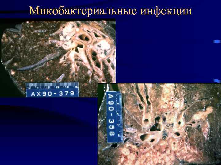 Микобактериальные инфекции 