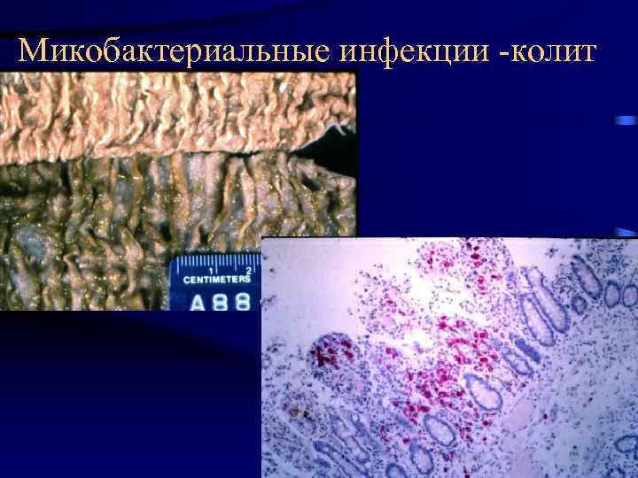 Микобактериальные инфекции -колит 