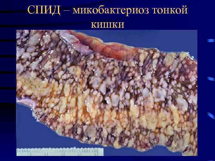 СПИД – микобактериоз тонкой кишки 