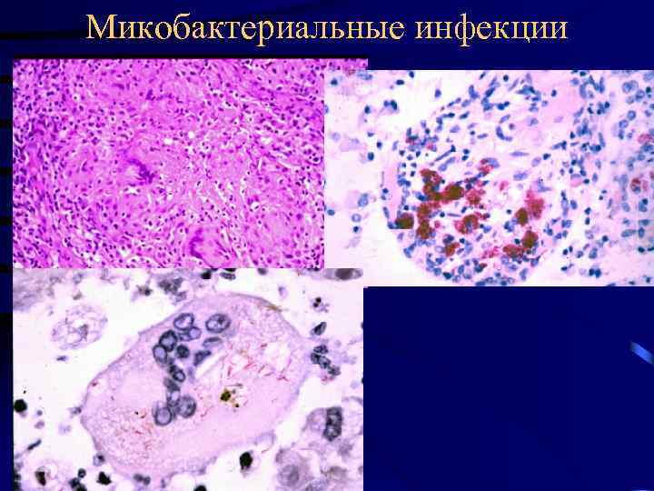 Микобактериальные инфекции 