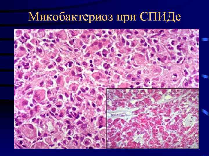 Микобактериоз при СПИДе 