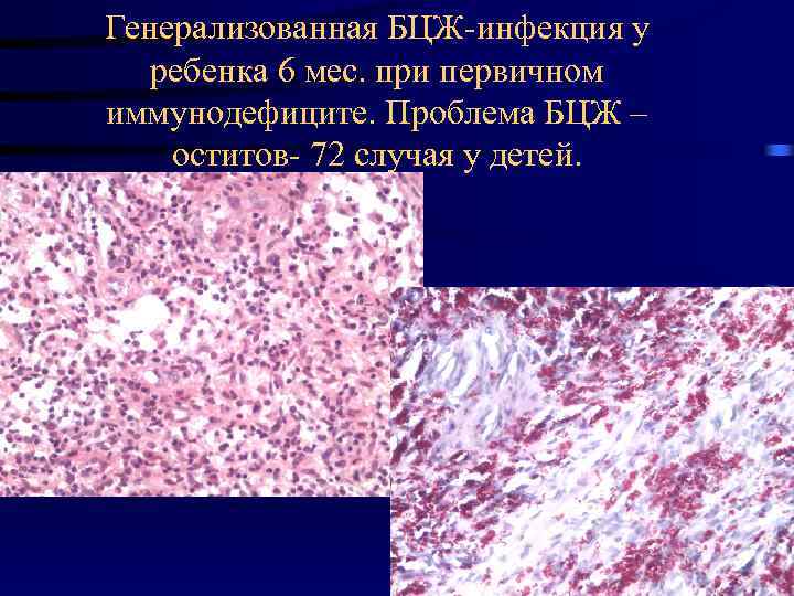 Генерализованная БЦЖ-инфекция у ребенка 6 мес. при первичном иммунодефиците. Проблема БЦЖ – оститов- 72