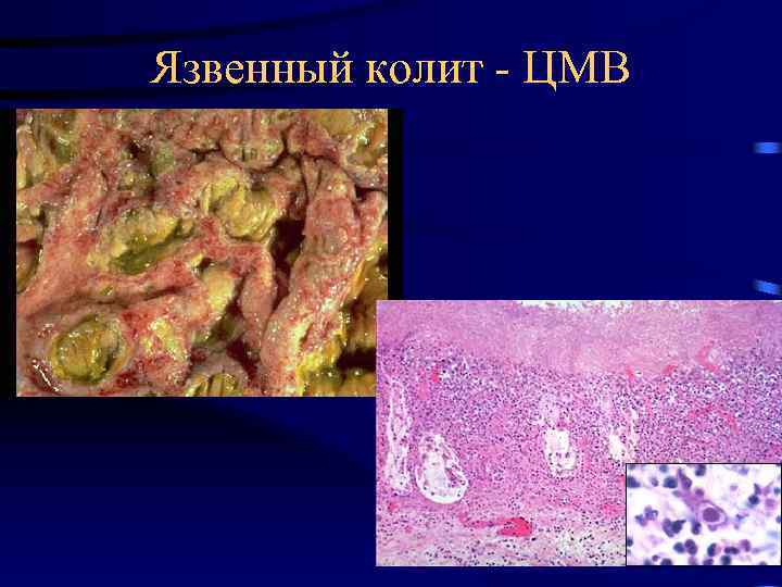 Язвенный колит - ЦМВ 