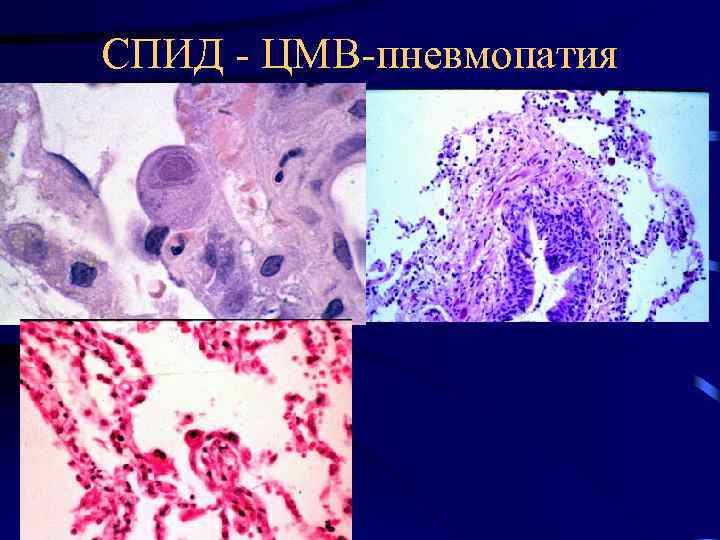 СПИД - ЦМВ-пневмопатия 