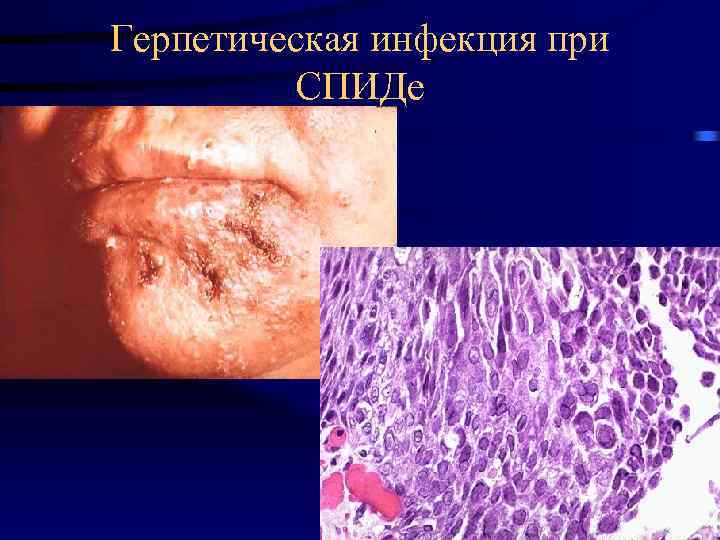 Герпетическая инфекция при СПИДе 