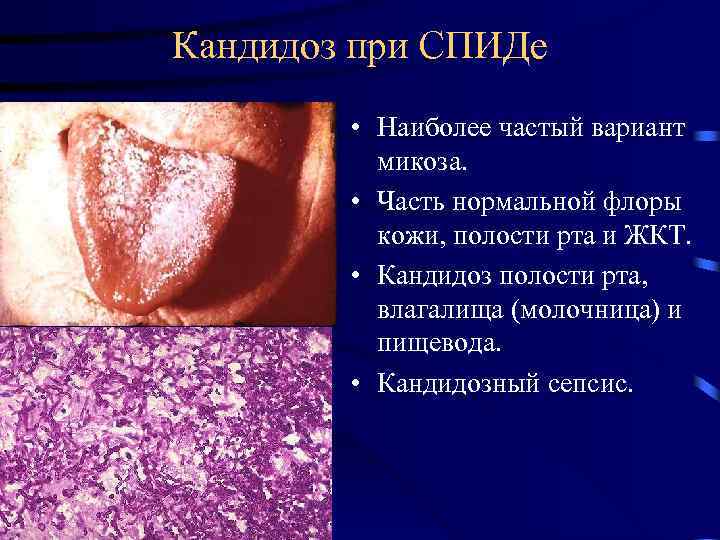 Кандидоз при СПИДе • Наиболее частый вариант микоза. • Часть нормальной флоры кожи, полости