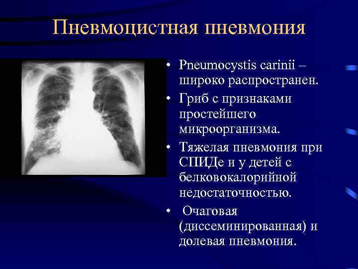 Пневмоцистная пневмония • Pneumocystis carinii – широко распространен. • Гриб с признаками простейшего микроорганизма.