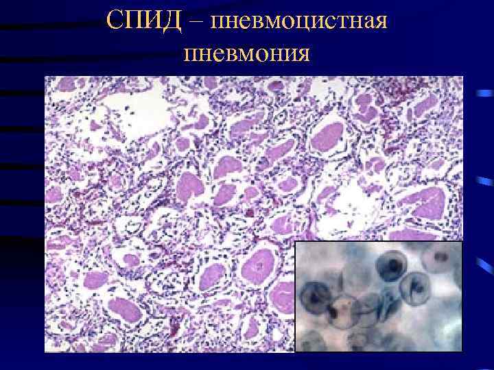 СПИД – пневмоцистная пневмония 