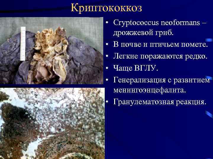 Криптококкоз • Cryptococcus neoformans – дрожжевой гриб. • В почве и птичьем помете. •