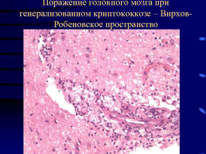Поражение головного мозга при генерализованном криптококкозе – Вирхов. Робеновское пространство 