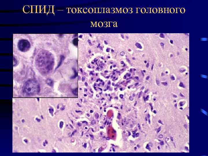 СПИД – токсоплазмоз головного мозга 