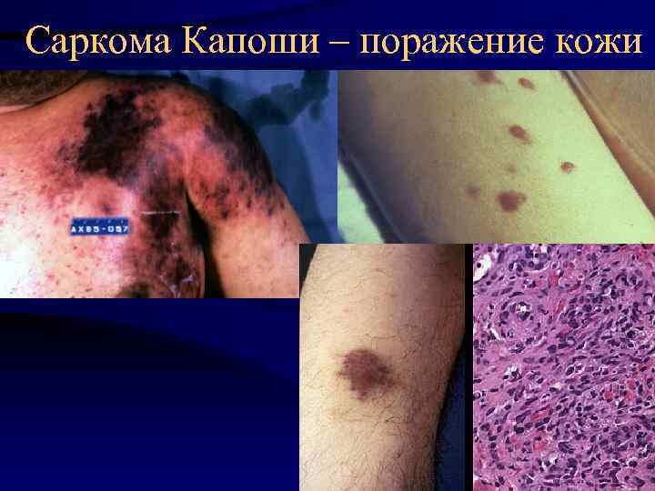 Саркома Капоши – поражение кожи 