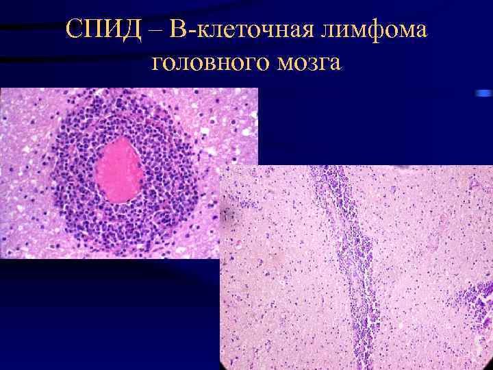 СПИД – В-клеточная лимфома головного мозга 