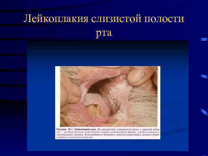 Лейкоплакия слизистой полости рта 