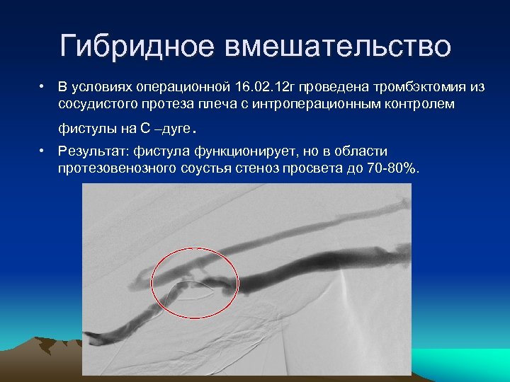 Гибридное вмешательство • В условиях операционной 16. 02. 12 г проведена тромбэктомия из сосудистого