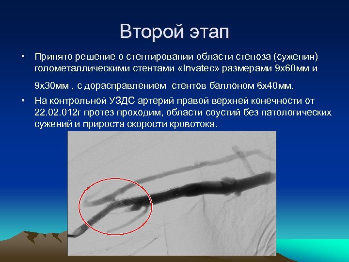 Второй этап • Принято решение о стентировании области стеноза (сужения) голометаллическими стентами «Invаtec» размерами