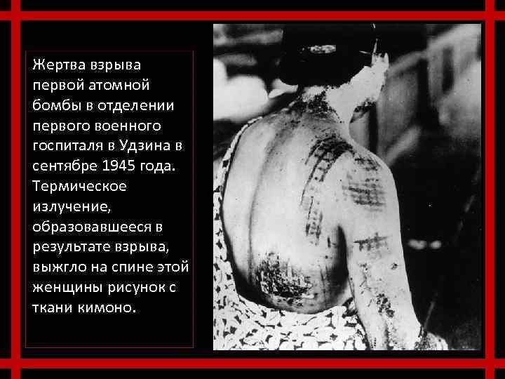 Жертва взрыва первой атомной бомбы в отделении первого военного госпиталя в Удзина в сентябре