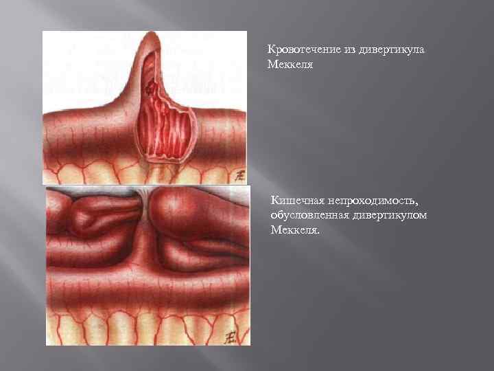 Кровотечение из дивертикула Меккеля Кишечная непроходимость, обусловленная дивертикулом Меккеля. 