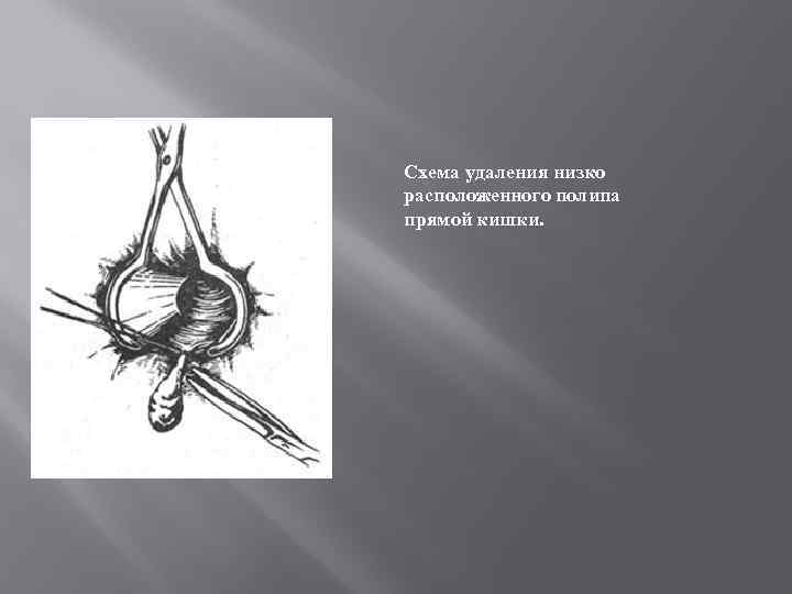 Схема удаления низко расположенного полипа прямой кишки. 