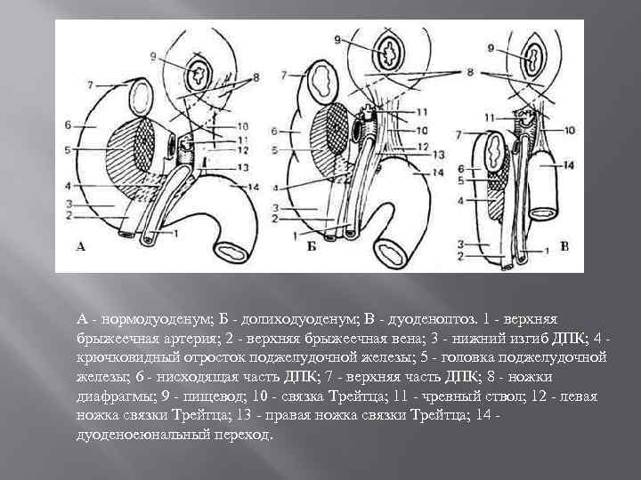 А нормодуоденум; Б долиходуоденум; В дуоденоптоз. 1 верхняя брыжеечная артерия; 2 верхняя брыжеечная вена;
