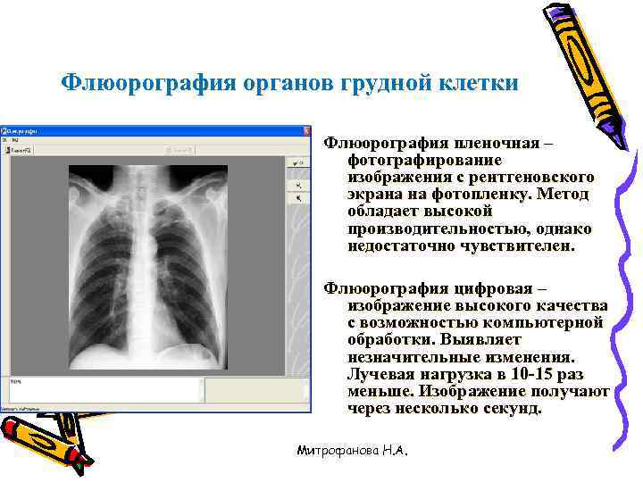 Рентген и флюорография в чем разница. Цифровая флюорография. Методика проведения флюорографии. Флюорографическое обследование грудной клетки.