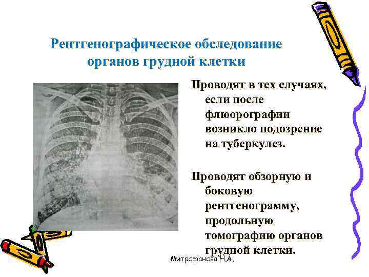 Рентгенографическое обследование органов грудной клетки Проводят в тех случаях, если после флюорографии возникло подозрение
