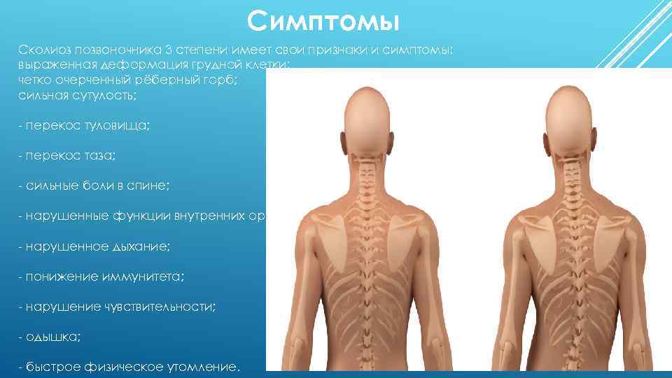 Симптомы Сколиоз позвоночника 3 степени имеет свои признаки и симптомы: выраженная деформация грудной клетки;