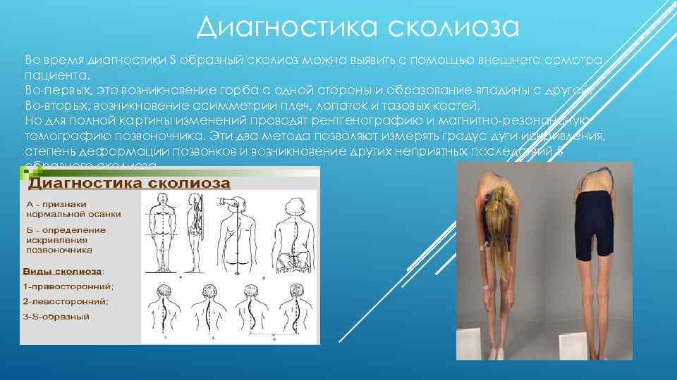 Можно ли сколиоз. Диагностика сколиоза. Методы выявления сколиоза. Диагностика при сколиозе.