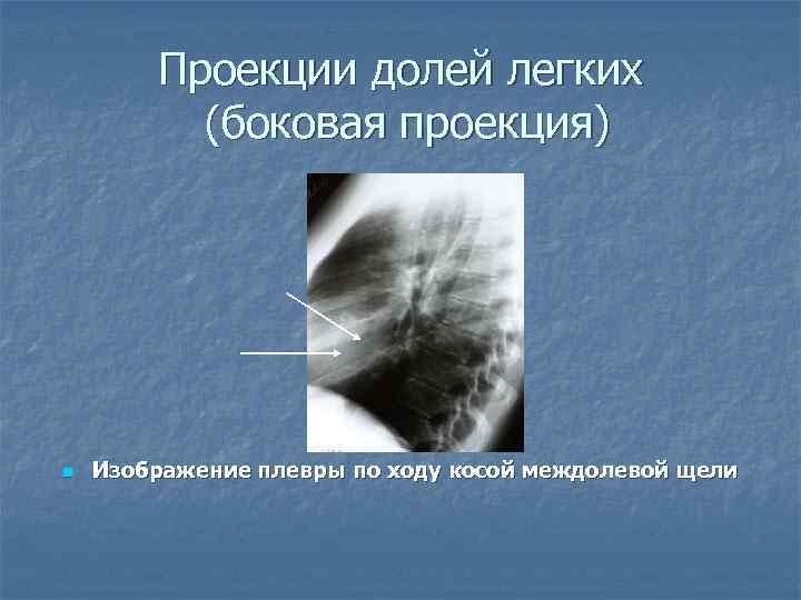 Проекции долей легких (боковая проекция) n Изображение плевры по ходу косой междолевой щели 