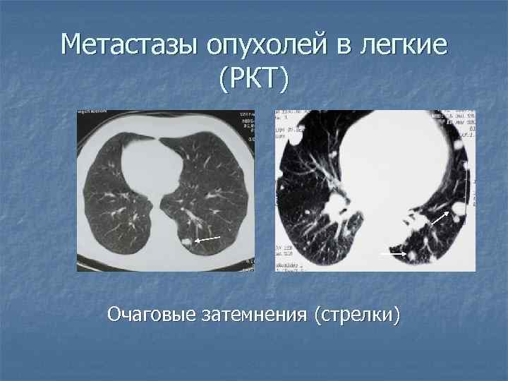 Метастазы опухолей в легкие (РКТ) Очаговые затемнения (стрелки) 