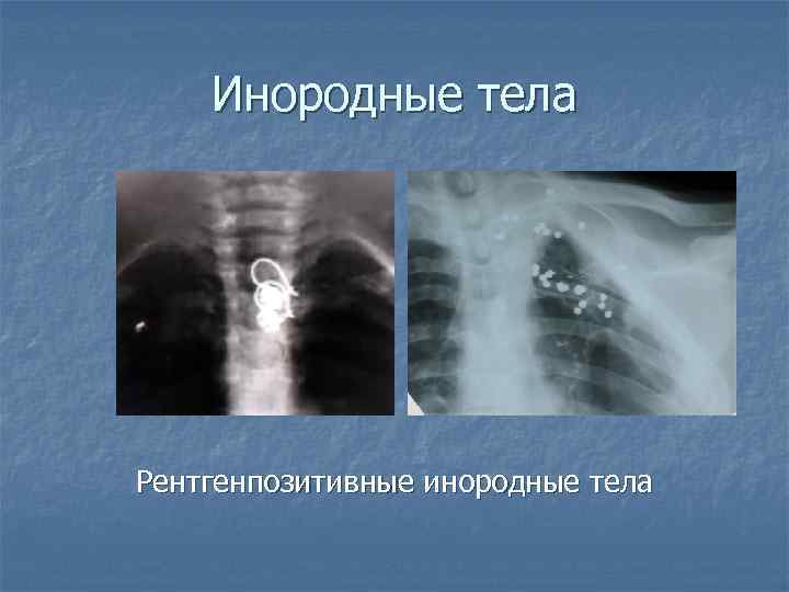 Инородные тела Рентгенпозитивные инородные тела 