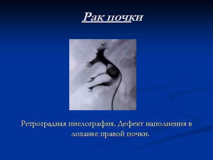 Рак почки Ретроградная пиелография. Дефект наполнения в лоханке правой почки. 