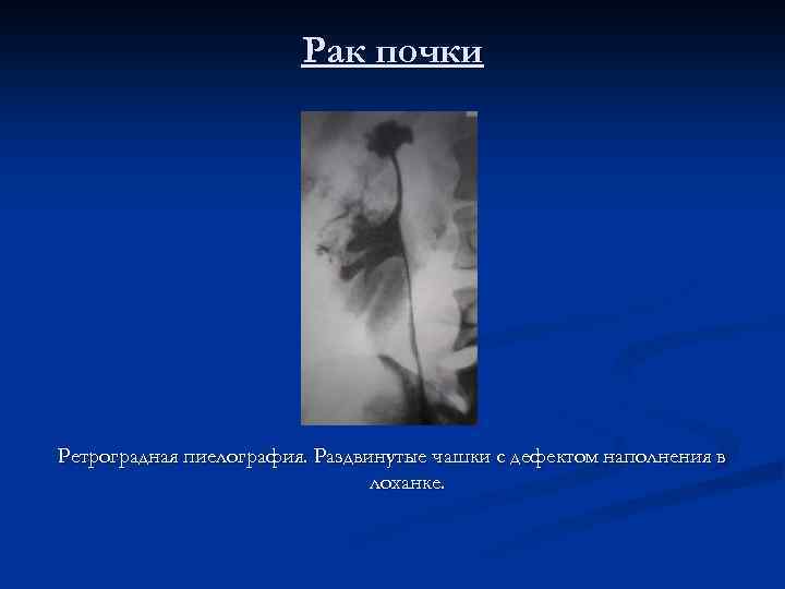 Рак почки Ретроградная пиелография. Раздвинутые чашки с дефектом наполнения в лоханке. 