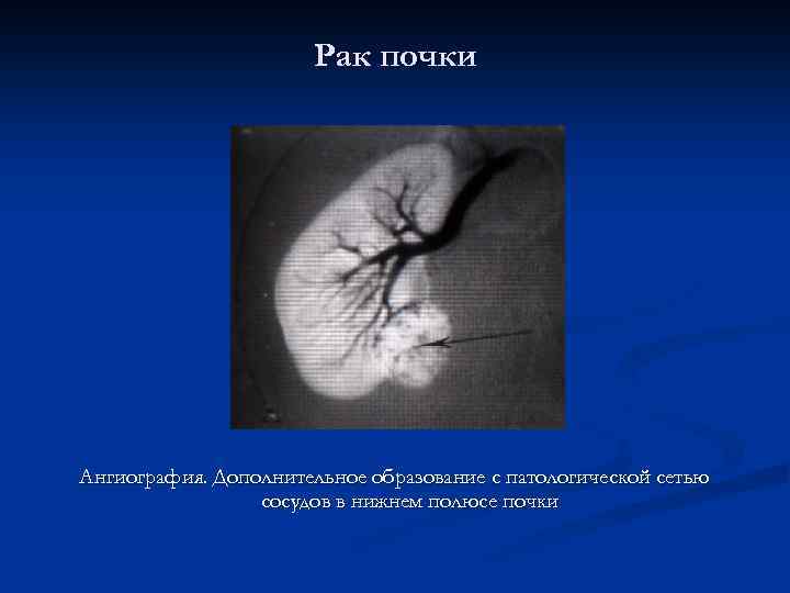 Рак почки Ангиография. Дополнительное образование с патологической сетью сосудов в нижнем полюсе почки 